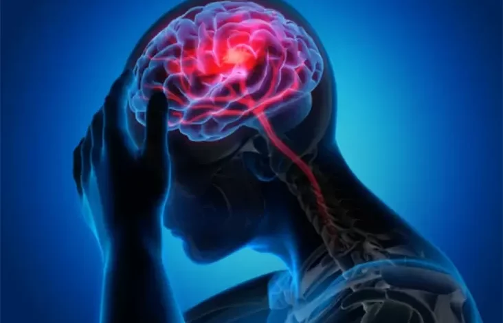 Gejala, Penyebab, serta juga Pencegahan Stroke Iskemik, Penyakit yang dimaksud Sebabkan Kematian Park Jin Ah