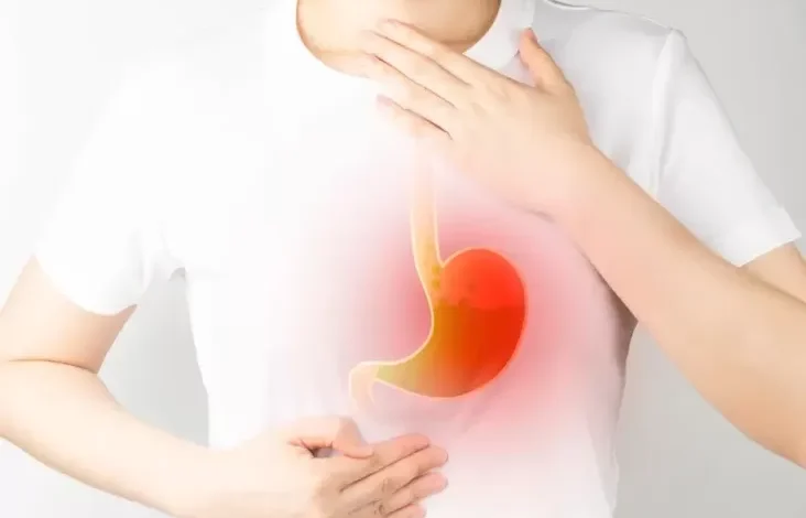 Apakah Gerd Disebabkan oleh Stres? Kenali Gejalanya
