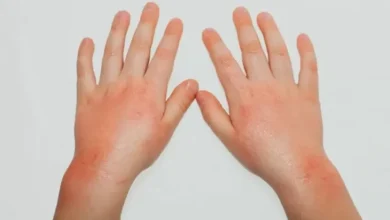 Mengenal Penyakit Scabies yang digunakan dimaksud Sering Dialami Santri: Penyebab, Gejala, dan juga juga Cara Mencegahnya