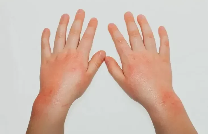 Mengenal Penyakit Scabies yang digunakan dimaksud Sering Dialami Santri: Penyebab, Gejala, dan juga juga Cara Mencegahnya