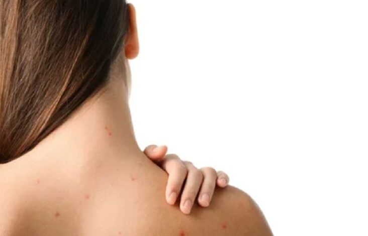 Tips Ampuh Menghilangkan Jerawat di dalam di Punggung, Harus Konsisten!