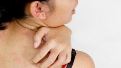Penderita sakit penyakit gula dan juga obesitas rentan terkena jamur di epidermis